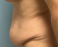 Tummy Tuck Before Photo by Julia Spears, MD, FACS; ,  - Case 50723