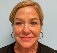 Botulinum Toxin After Photo by Julia Spears, MD, FACS; ,  - Case 50727