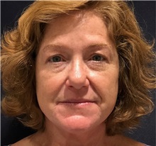 Botulinum Toxin Before Photo by Julia Spears, MD, FACS; ,  - Case 50727