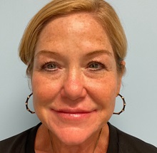 Lip Augmentation/Enhancement After Photo by Julia Spears, MD, FACS; ,  - Case 50729