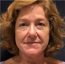 Lip Augmentation/Enhancement Before Photo by Julia Spears, MD, FACS; ,  - Case 50729