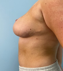Breast Reduction After Photo by Julia Spears, MD, FACS; Marlton, NJ - Case 50774