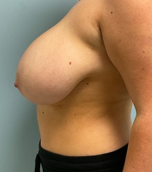 Breast Reduction Before Photo by Julia Spears, MD, FACS; Marlton, NJ - Case 50774