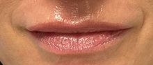 Lip Augmentation/Enhancement After Photo by Julia Spears, MD, FACS; Marlton, NJ - Case 50777