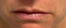 Lip Augmentation/Enhancement Before Photo by Julia Spears, MD, FACS; Marlton, NJ - Case 50777