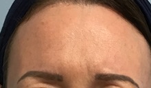 Botulinum Toxin After Photo by Julia Spears, MD, FACS; Marlton, NJ - Case 50779