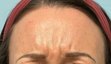 Botulinum Toxin Before Photo by Julia Spears, MD, FACS; Marlton, NJ - Case 50779
