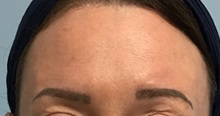 Botulinum Toxin After Photo by Julia Spears, MD, FACS; Marlton, NJ - Case 50779