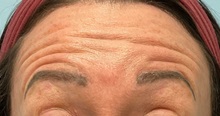 Botulinum Toxin Before Photo by Julia Spears, MD, FACS; Marlton, NJ - Case 50779