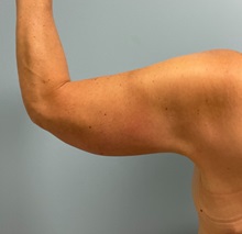 Arm Lift After Photo by Julia Spears, MD, FACS; Marlton, NJ - Case 50871