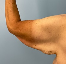 Arm Lift Before Photo by Julia Spears, MD, FACS; Marlton, NJ - Case 50871