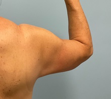 Arm Lift After Photo by Julia Spears, MD, FACS; Marlton, NJ - Case 50871
