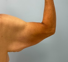 Arm Lift Before Photo by Julia Spears, MD, FACS; Marlton, NJ - Case 50871