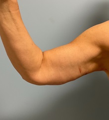 Arm Lift After Photo by Julia Spears, MD, FACS; Marlton, NJ - Case 50871