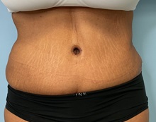 Tummy Tuck After Photo by Julia Spears, MD, FACS; Marlton, NJ - Case 50897
