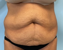 Tummy Tuck Before Photo by Julia Spears, MD, FACS; Marlton, NJ - Case 50897