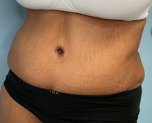 Tummy Tuck After Photo by Julia Spears, MD, FACS; Marlton, NJ - Case 50897