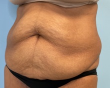 Tummy Tuck Before Photo by Julia Spears, MD, FACS; Marlton, NJ - Case 50897