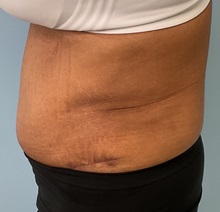 Tummy Tuck After Photo by Julia Spears, MD, FACS; Marlton, NJ - Case 50897
