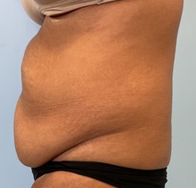 Tummy Tuck Before Photo by Julia Spears, MD, FACS; Marlton, NJ - Case 50897