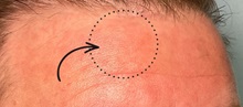 Wound Care After Photo by Julia Spears, MD, FACS; Marlton, NJ - Case 50907