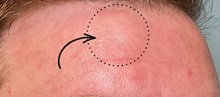 Wound Care Before Photo by Julia Spears, MD, FACS; Marlton, NJ - Case 50907