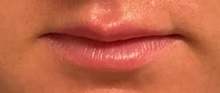 Dermal Fillers After Photo by Julia Spears, MD, FACS; ,  - Case 50911