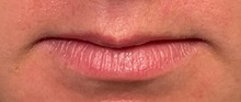 Dermal Fillers Before Photo by Julia Spears, MD, FACS; ,  - Case 50911