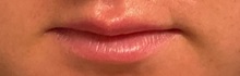 Lip Augmentation/Enhancement After Photo by Julia Spears, MD, FACS; ,  - Case 50910