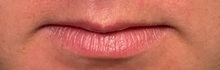 Lip Augmentation/Enhancement Before Photo by Julia Spears, MD, FACS; ,  - Case 50910