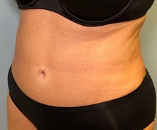 Liposuction After Photo by Julia Spears, MD, FACS; ,  - Case 50913