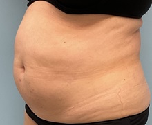 Liposuction Before Photo by Julia Spears, MD, FACS; ,  - Case 50913