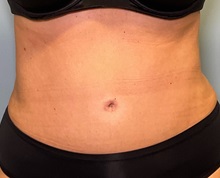 Liposuction After Photo by Julia Spears, MD, FACS; ,  - Case 50913