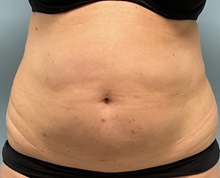 Liposuction Before Photo by Julia Spears, MD, FACS; ,  - Case 50913