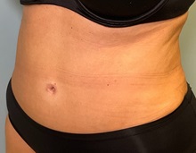 Tummy Tuck After Photo by Julia Spears, MD, FACS; ,  - Case 50912