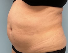 Tummy Tuck Before Photo by Julia Spears, MD, FACS; ,  - Case 50912