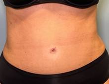 Tummy Tuck After Photo by Julia Spears, MD, FACS; ,  - Case 50912