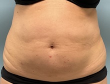 Tummy Tuck Before Photo by Julia Spears, MD, FACS; ,  - Case 50912