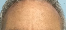 Wound Care After Photo by Julia Spears, MD, FACS; ,  - Case 50917