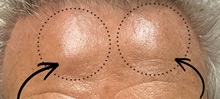 Wound Care Before Photo by Julia Spears, MD, FACS; ,  - Case 50917
