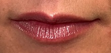 Botulinum Toxin After Photo by Julia Spears, MD, FACS; ,  - Case 50957