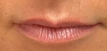 Botulinum Toxin Before Photo by Julia Spears, MD, FACS; ,  - Case 50957
