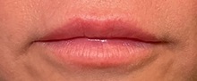 Botulinum Toxin After Photo by Julia Spears, MD, FACS; ,  - Case 50966