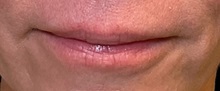 Botulinum Toxin Before Photo by Julia Spears, MD, FACS; ,  - Case 50966