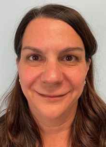 Laser Skin Resurfacing After Photo by Julia Spears, MD, FACS; Marlton, NJ - Case 51108