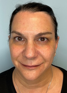 Laser Skin Resurfacing Before Photo by Julia Spears, MD, FACS; Marlton, NJ - Case 51108