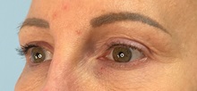 Eyelid Surgery After Photo by Julia Spears, MD, FACS; Marlton, NJ - Case 51155