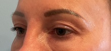 Eyelid Surgery Before Photo by Julia Spears, MD, FACS; Marlton, NJ - Case 51155