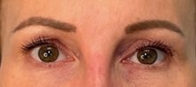 Eyelid Surgery After Photo by Julia Spears, MD, FACS; Marlton, NJ - Case 51155