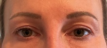 Eyelid Surgery Before Photo by Julia Spears, MD, FACS; Marlton, NJ - Case 51155